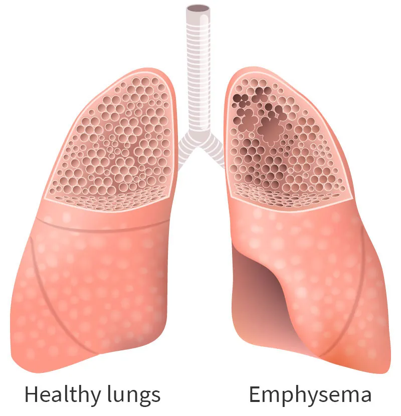 Emphysema